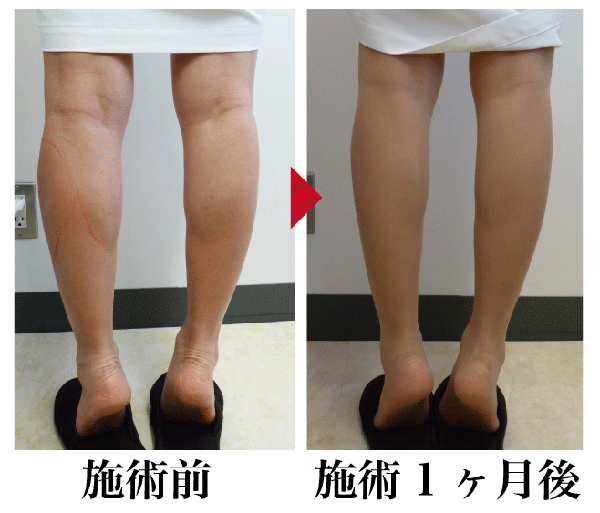 筋肉質 の 足 を 細く する 方法 筋肉質な脚を細くする方法 筋肉太りを細くする3か条とは